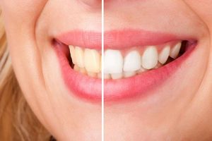 Teeth Whitening | Alex Bratic Dental Care - Dentist Beenleigh