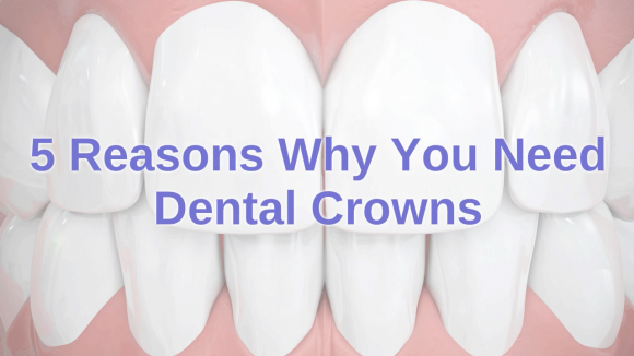 beenleigh-dentist-tips-5-reasons-why-you-need-dental-crowns