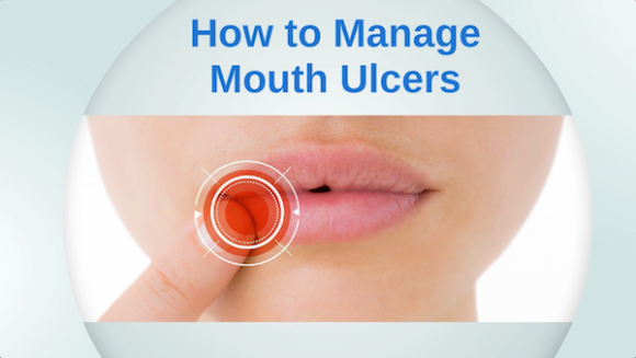 beenleigh-dentist-advice-how-to-manage-mouth-ulcers