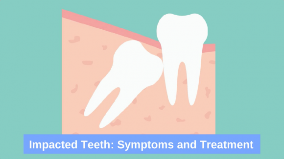 The Signs and Symptoms of Impacted Teeth