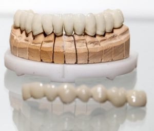 How Long Do Dental Crowns Last?