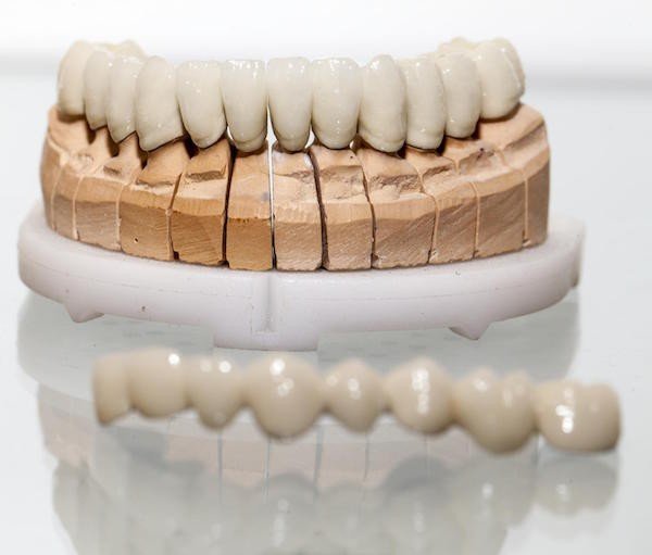 How Long Do Dental Crowns Last? Alex Bratic Dental Care