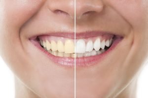 What’s The Best Way to Whiten Yellow Teeth beenleigh dentist