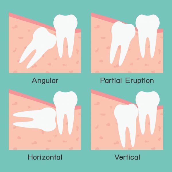 Wisdom Tooth Extraction In The Beenleigh Area Alex Bratic Dental Care
